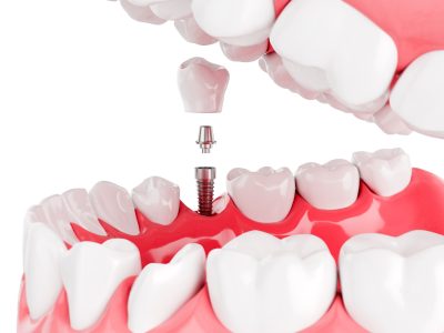 Close up Process Implants teeth health care on white background. Selective focus. 3D Render. Close up Process Implants teeth health care on white background. Selective focus. 3D Render.